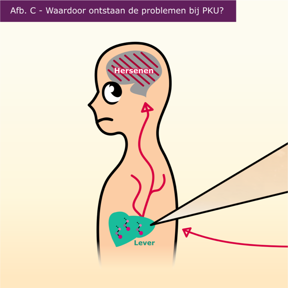 PKU (Fenylketonurie)  infographic afbeelding 0